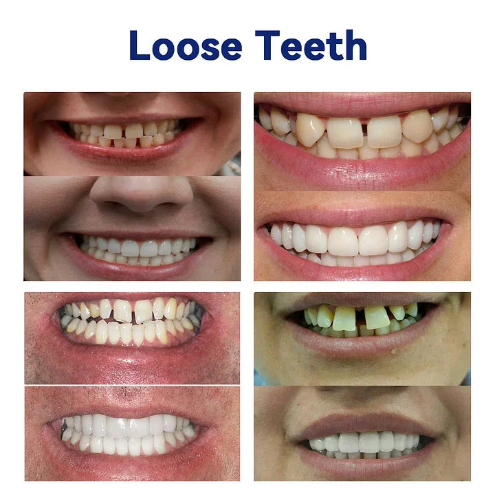 Complete Denture Set — Eat, Smile & Speak with Confidence