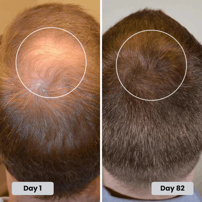 Red Light Therapy Cap for Hair Regrowth Treatment