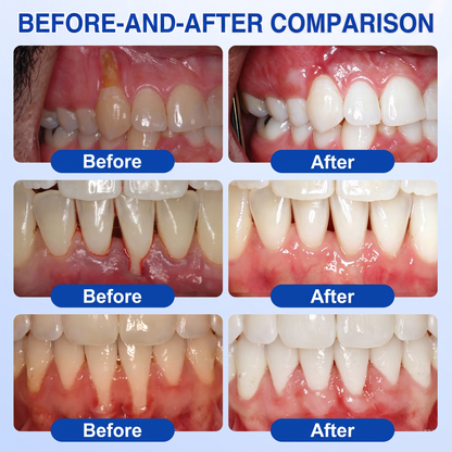 Myblexy® 🦷GumRevive periodontal repair gel🌿🌿🌿