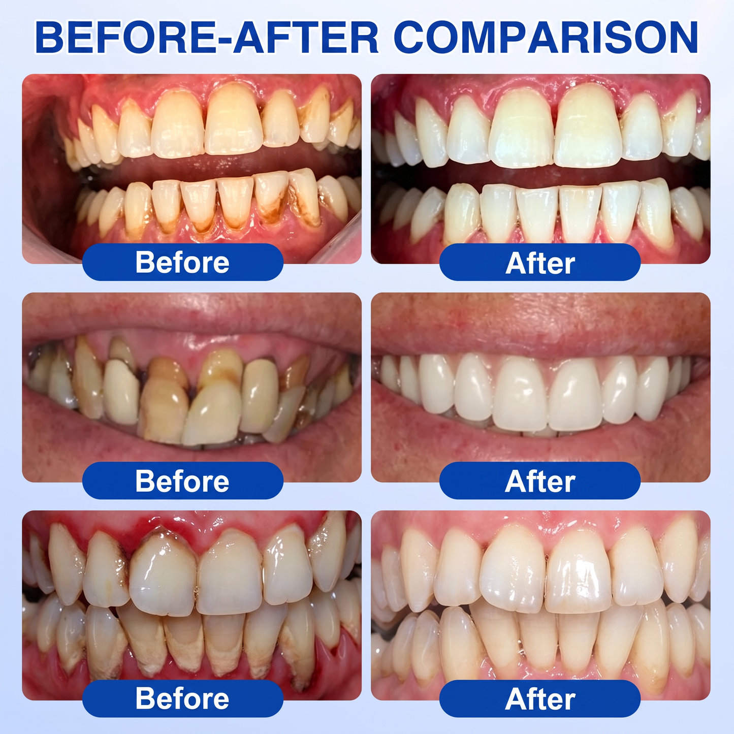 Myblexy® 🦷GumRevive periodontal repair gel🌿🌿🌿