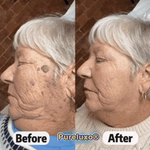 Myblexy® Skin Tag Remover Roller💥💥💥