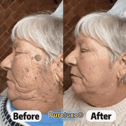 Myblexy® Skin Tag Remover Roller💥💥💥