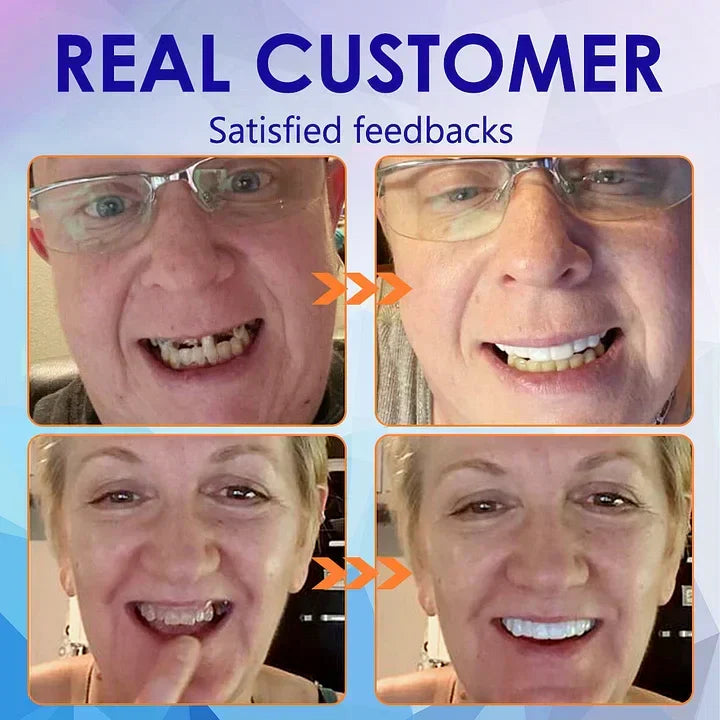 Complete Denture Set — Eat, Smile & Speak with Confidence
