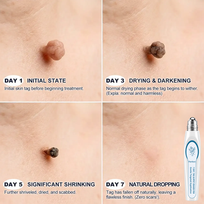 Myblexy® Skin Tag Remover Roller💥💥💥