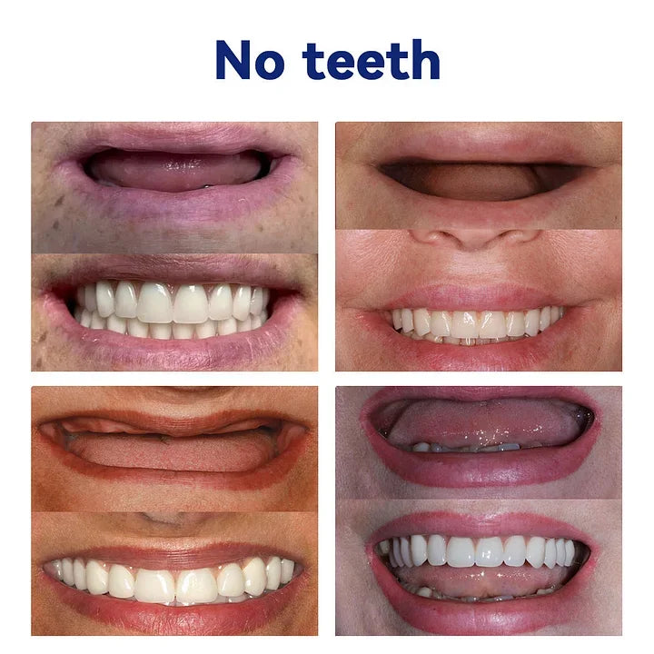 Complete Denture Set — Eat, Smile & Speak with Confidence