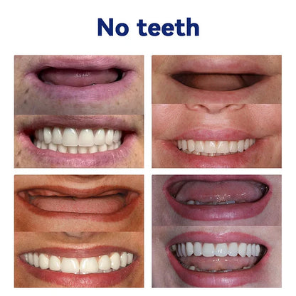Complete Denture Set — Eat, Smile & Speak with Confidence